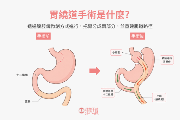 胃繞道手術示意圖